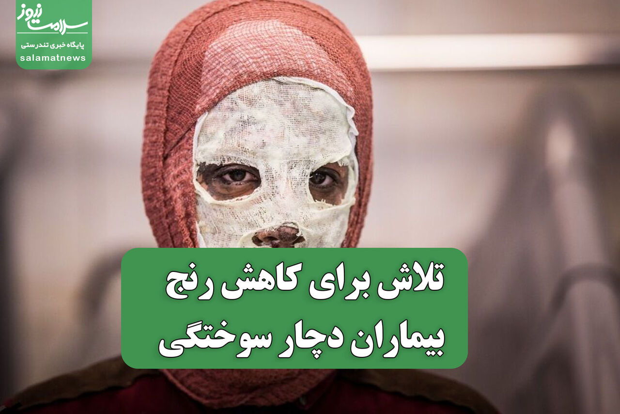 تلاش برای کاهش رنج بیماران دچار سوختگی
