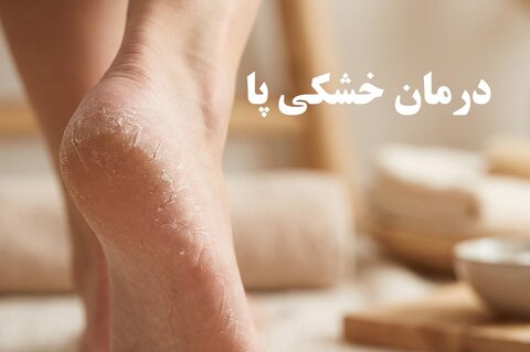 درمان خشکی پا؛ از علت های ساده تا روش های موثر مراقبت و درمان