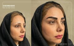 بهترین سن برای کاشت ابرو؛ آیا در یائسگی و سنین بالا امکان‌پذیر است؟