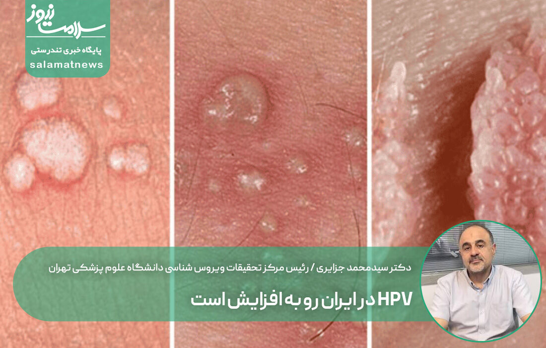 HPV در ایران رو به افزایش است / نه آموزش داریم، نه واکسیناسیون!