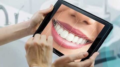 بررسی مراحل طراحی لبخند دیجیتال و کاربرد ونیرهای بدون تراش
