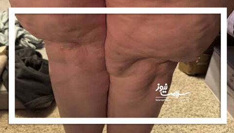 چربی ذخیره در پا از بیماری است نه چاقی