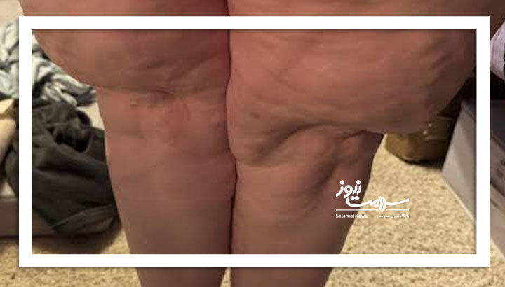 چربی ذخیره در پا از بیماری است نه چاقی