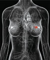 تشخیص به موقع سرطان پستان از بروز لنف ادم پیشگیری می‌كند