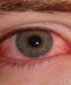 قرمزی چشم بارزترین علامت بیماری "كنژنكتیویت " است