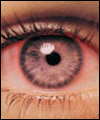 عفونت، شایع ترین علت قرمزی چشم است