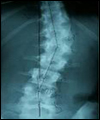 اسکولیوز (کج پشتی) منشا کمردد و گردن دردهای مدرن است