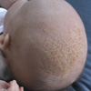 درمان درماتیت سبوره نوزادان