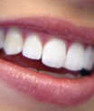 آیا سفید کردن دندانها ماندگاری دارد؟
