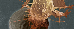 تشخیص میزان انتشار سلول‌های سرطانی با نانولوله‌های کربنی