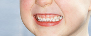 دندان قروچه از علائم اضطراب در دوران کودکی است 