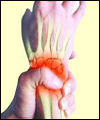 ۷ درمان مفصل آرتریتی