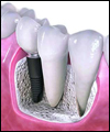 جایگزینی دندان با ایمپلنت