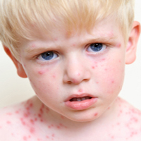 بیماری کاوازاکی، بیماری کودک زیر 5 سال