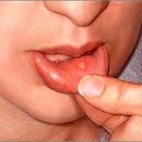 درمان های طبیعی آفت دهان که شما نمی دانید!