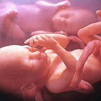 آمار بالای مرگ و میر مادران در سقط‌ جنین‌های ناامن