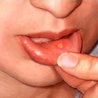 زخم‌های دهانی بیشتر از سه هفته را جدی بگیرید