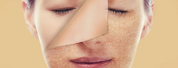 چند روش درمان خانگی برای از بین بردن جوش های صورت