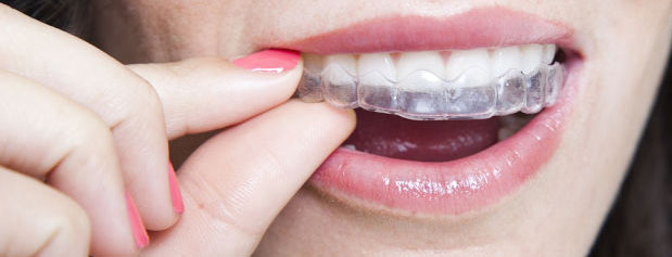 میانبری برای ردیف شدن دندان‌ها