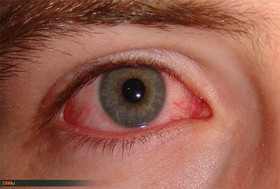 ورم بهاره چشمی چیست؟