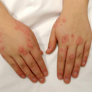 بیماری‌های شایع پوستی در بهار/ راهکارهای دور ماندن از آلرژی