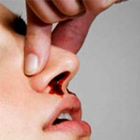برای قطع خونریزی بینی چه باید کرد؟
