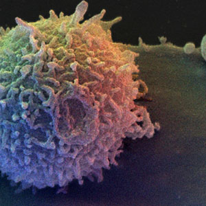 حذف قند از سطح سلول های تومور، جدیدترین شیوه درمان سرطان