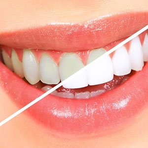 دستورالعمل/دندان‌های خود را بدون نیاز به دندانپزشک سفید کنید