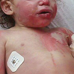 نجات کودک سوخته با استفاده از پوست اهدایی