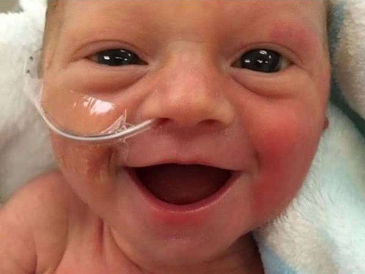 عکس/تولد کودکی که «شادترین نوزاد نارس جهان» شده است
