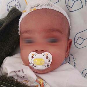 انتقال نوزاد ضربه مغزی شده به شیرخوارگاه اصفهان/ خارج کردن خون‌های لخته شده از مغز نوزاد