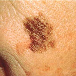 سرطان های پوستی جز 6 سرطان شایع در جهان