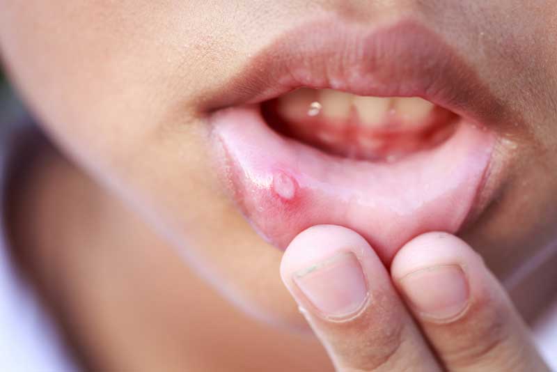 چه زمانی آفت از نشانه های سرطان دهان میشود؟