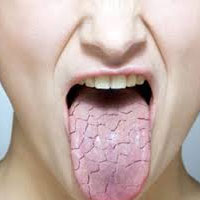 درمان‌هایی موثر برای خشکی دهان