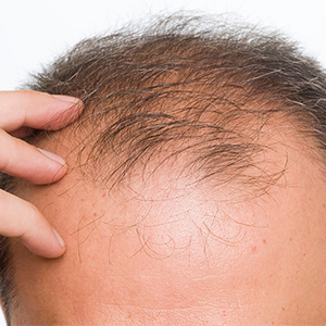 داروی آرتروز به رشد مجدد موها کمک می کند
