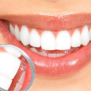 آنچه درمورد لامینیت دندان باید بدانیم
