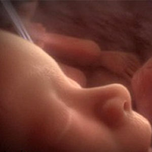 ام آر آی از جنین، نقشه راه اعمال جراحی درون رحمی است