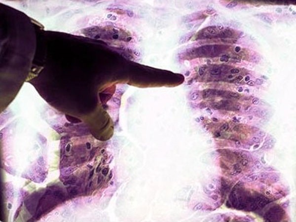 خطر آزبست و سرطان در منطقه پلاسکو