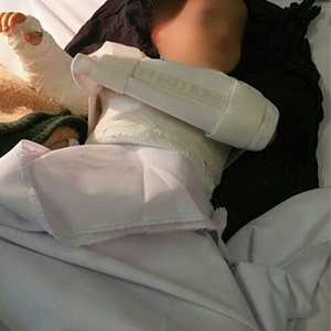 پاسخ دانشگاه علوم پزشکی اصفهان در پی جراحی اشتباه دست کودک 2 ساله