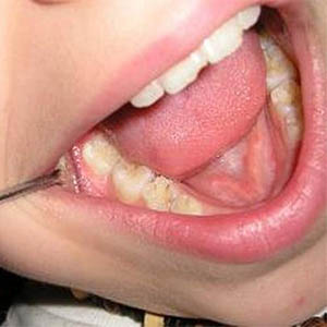 دندان های پوسیده کودکان ۱۲ ساله ایرانی رو به افزایش است
