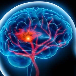 علائم و نشانه‌های سکته مغزی