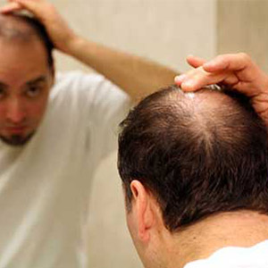 ژنتیک عامل ریزش مو در مردان
