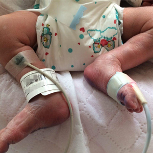 واکنش رییس مجتمع بیمارستانی امام خمینی به اخبار ترخیص نوزادی که دچار سوختگی شده بود