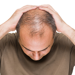 راه درمان ریزش مو برای خانم ها/ آقایان با این روش ها طاسی خود را پنهان کنند