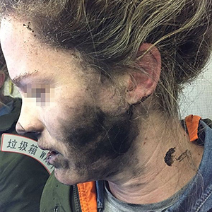 عکس/صورت مسافر زن هواپیما به دلیل انفجار هدفون سوخت