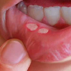 داروهای موثر برای درمان آفت دهان