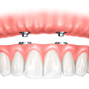 روش کاشت ایمپلنت در افرادی که دندانی در دهان ندارند