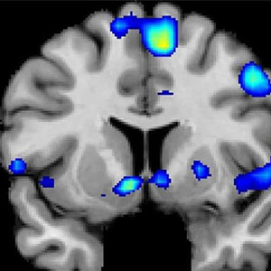 تشخیص محل HIV در مغز با اسکن MRI