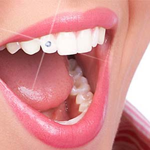 عوارض کاشت نگین بر روی دندان‌ها