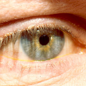 لکه‌های زرد داخل چشم را جدی بگیرید